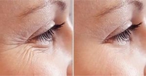 Plasma Before_After Eyes